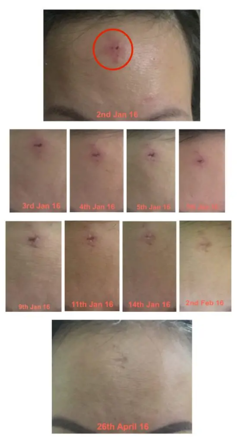 Cystic Acne