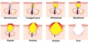 Cystic Acne