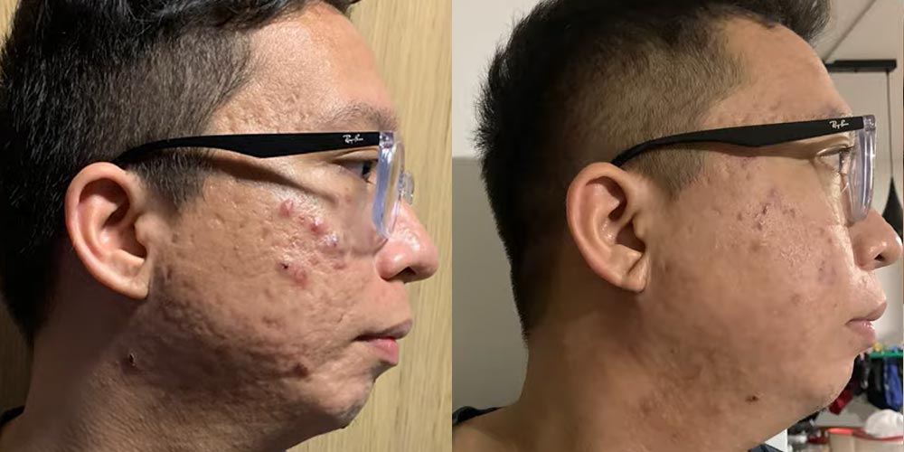 Skinlycious result 04