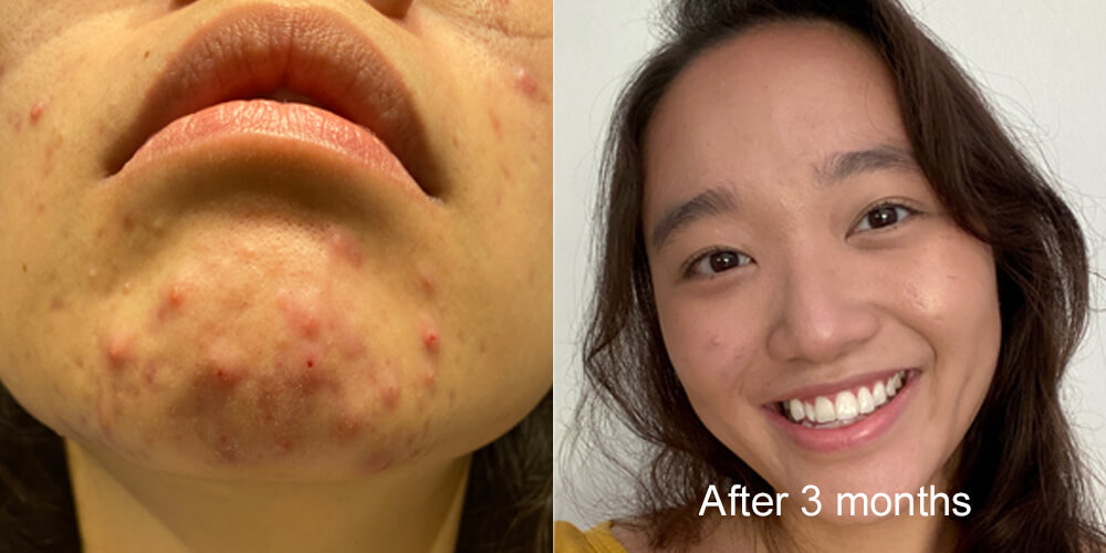 Skinlycious result 05