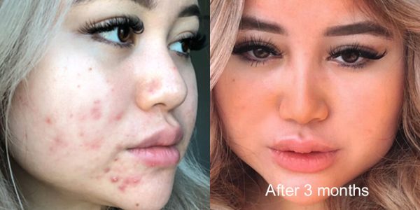 Skinlycious result 06