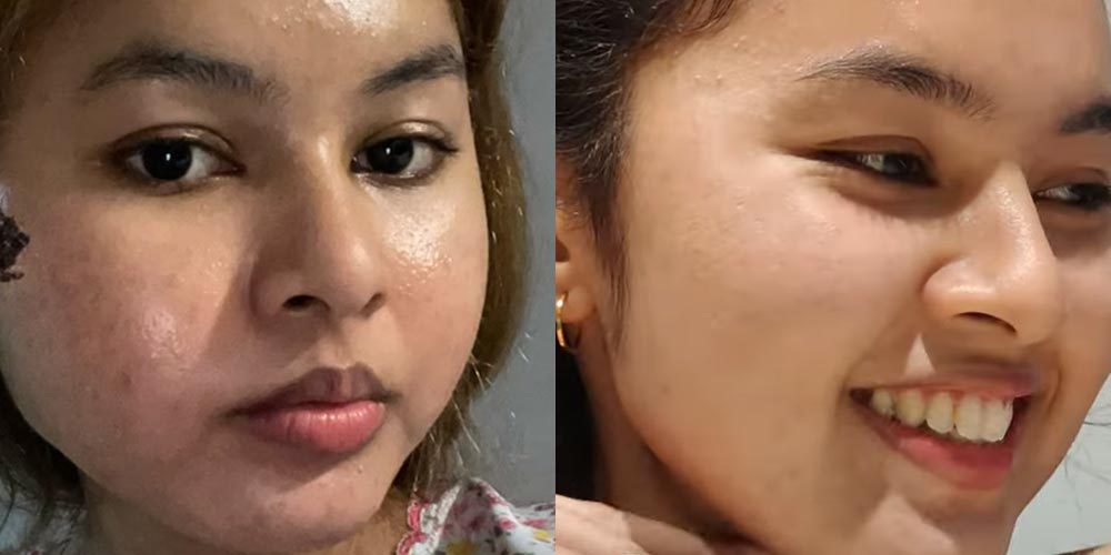 Skinlycious result 02