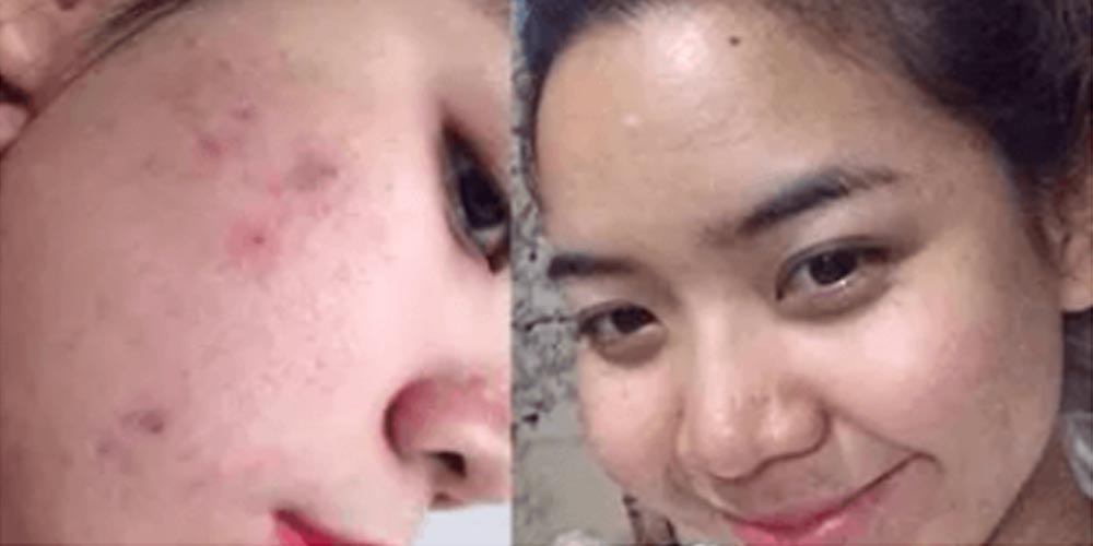 Skinlycious result 04