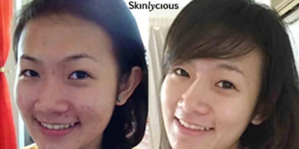 Skinlycious result 09