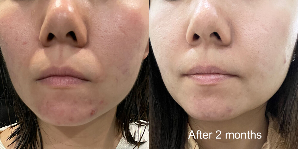 Skinlycious result 10